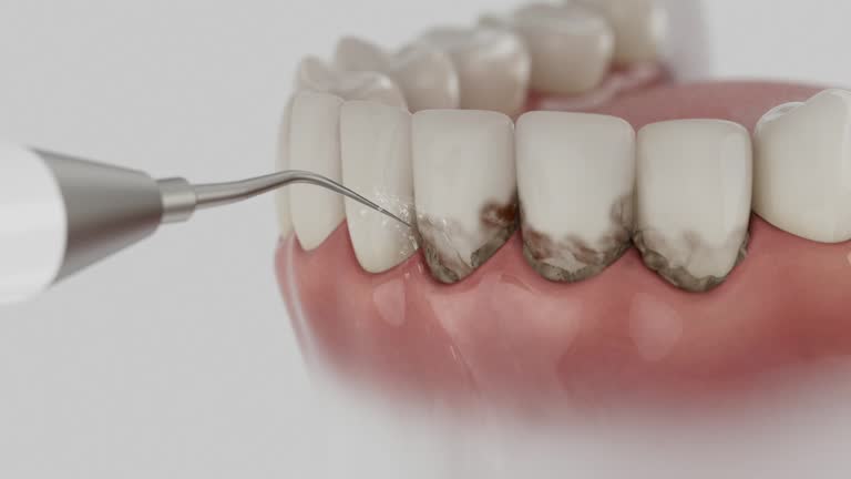 Trusted Root Canal Treatment service in Lawrence, IN - Dentist Open Now